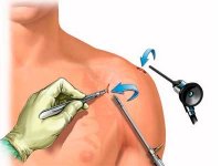 Артроскопия плечевого сустава 