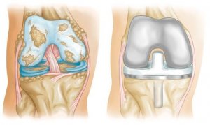 Knee arthroplasty 